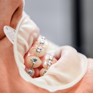 Aftercare Do’s and Don’ts with Braces in Sacramento