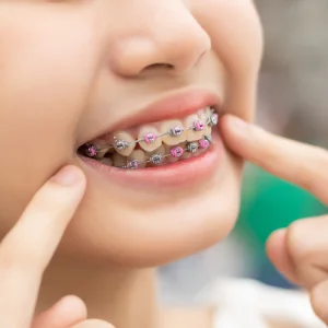Clear braces in Sacramento — close-up of a smiling mouth wearing braces, with fingers pointing to the brackets and wires