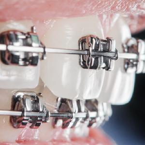 How to Choose the Right Type of Braces in Sacramento