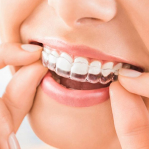 Lifestyle Tips for Living With Clear Braces in Sacramento