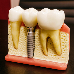 Can You Get Dental Implants in Sacramento if You Have Gum Disease?