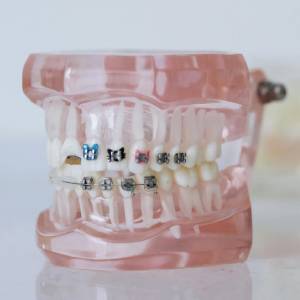 Straighten Your Smile with Affordable Braces in Sacramento