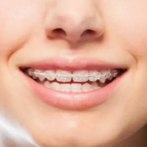 What to Expect with Clear Braces in Sacramento?